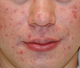 60-Day Sensitive Acne Kit