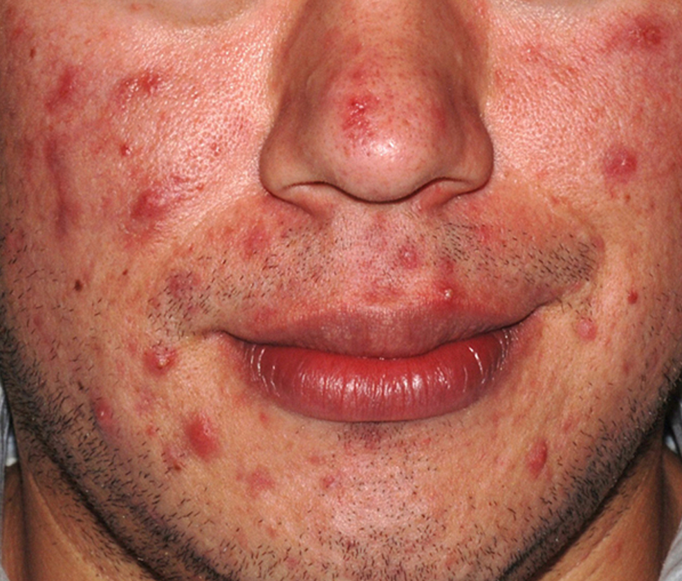 30-Day Sensitive Skin Acne Clearing 3 Step Treatment with Salicylic Acid