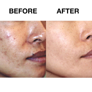 60 Day Benzoyl Peroxide Acne Lotion