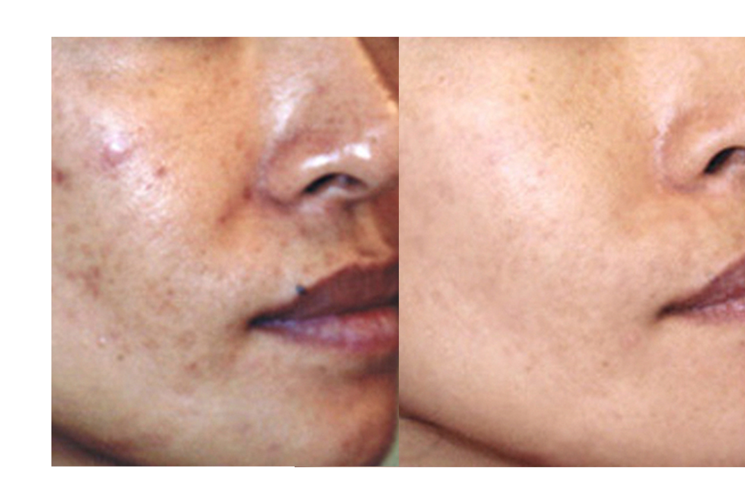 30-Day Sensitive Skin Acne Clearing 3 Step Treatment with Salicylic Acid