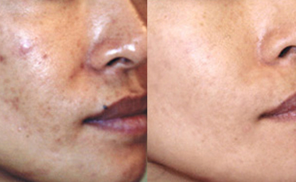 60-Day Clarifying & Renewing Skin Toner with 1% Salicylic Acid