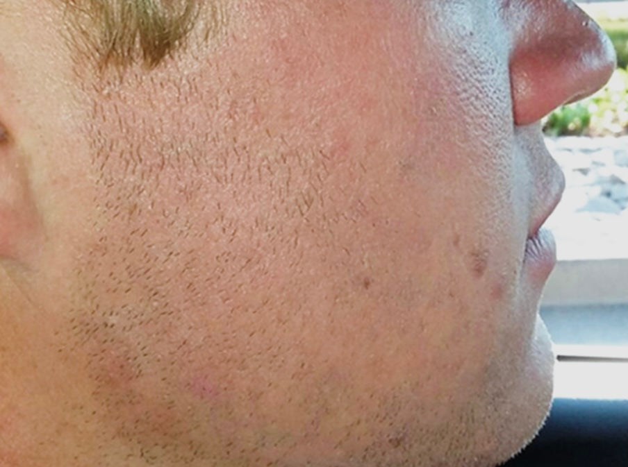 After using Clearogen