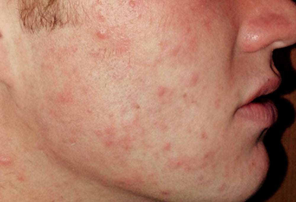 Before using Clearogen