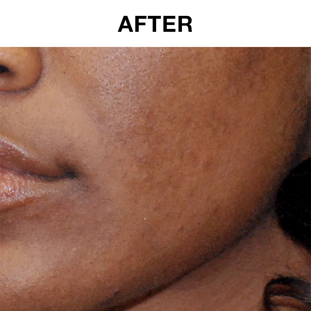 30-Day Ultra-Foaming Facial Cleanser with Salicylic Acid