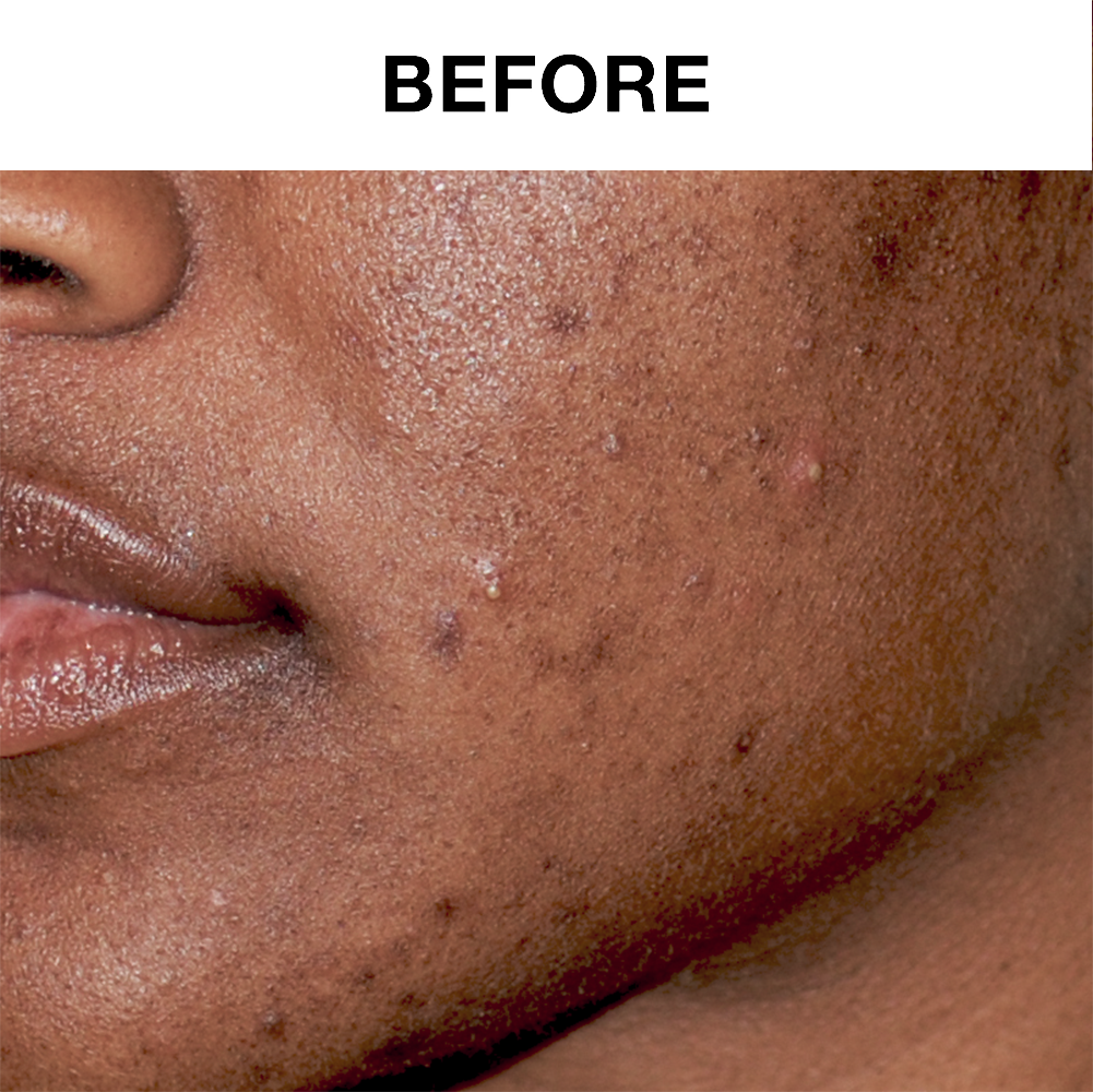 30-Day Ultra-Foaming Facial Cleanser with Salicylic Acid