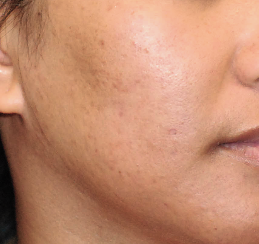 After using Clearogen