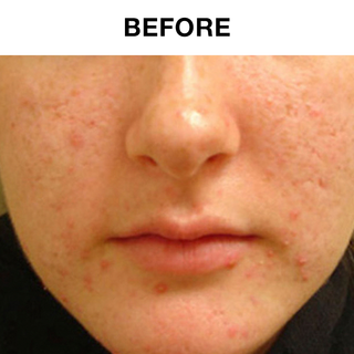 60 Day Benzoyl Peroxide Acne Lotion